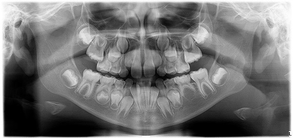 Ortopantomografía - Radiografía Dental Panorámica